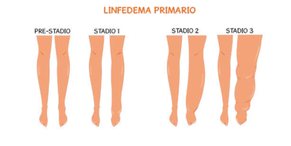 Linfedema PRIMARIO